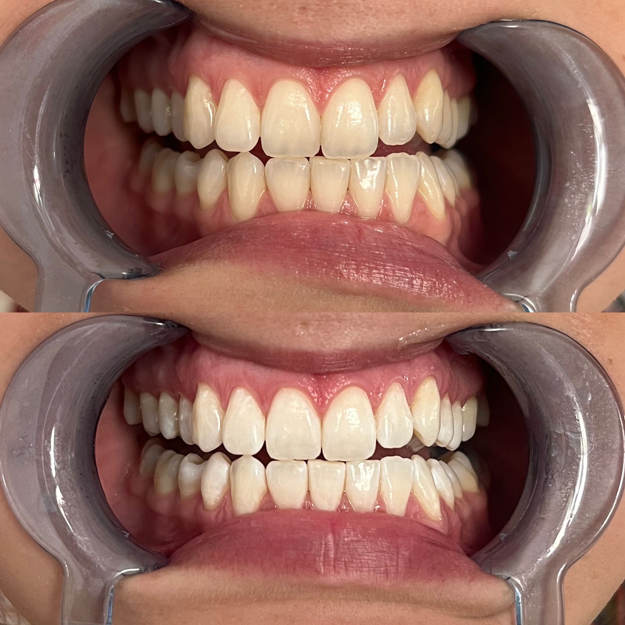 Zahnbleaching
